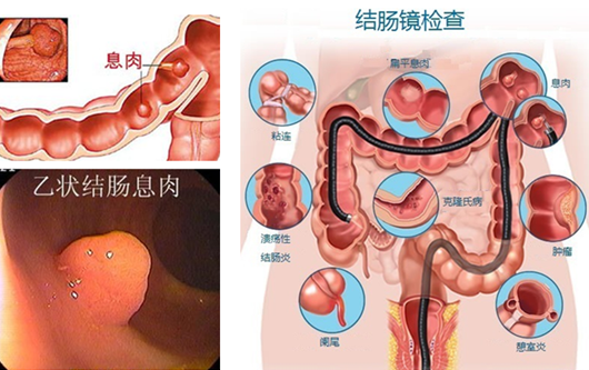 萎縮性胃炎真的“很?chē)樔恕?？看完這“七個(gè)事實(shí)”你就明白了