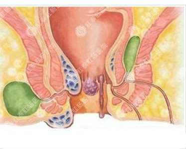 南寧哪個(gè)醫院可以做肛周膿腫？