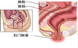 南寧治療脫肛哪家醫院好？南寧脫肛治療多少錢(qián)？